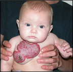 Child with a vascular birthmark