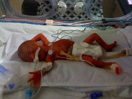 Olivia in the NICU