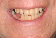 After prosthodontic treatment