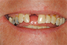 Before prosthodontic treatment