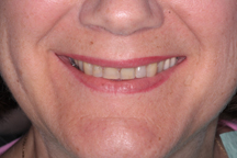 Before Prosthodontic Treatment