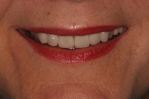 After Prosthodontic Treatment