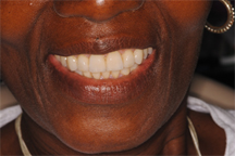 After prosthodontic treatment