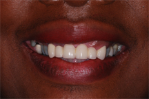Before prosthodontic treatment