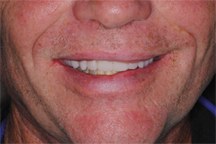 After  prosthodontic treatment