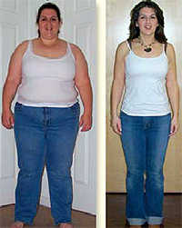 before and after weight loss surgery