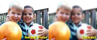 Normal vs Cataract Vision